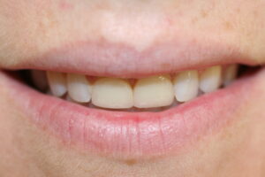 ZA02 before old veneers with gummy smile
