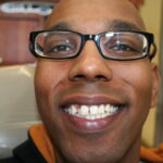 before veneers