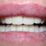 after crowns and veneers