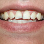 cracked and chipped teeth