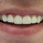 veneers