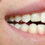 diamond glued on the tooth