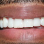 markees after veneers close space between teeth