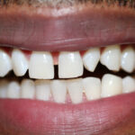 markees before space between teeth